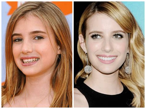 before and after celebrity veneer teeth